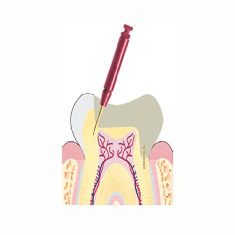 Nordin Retention Pins 12/Pkg